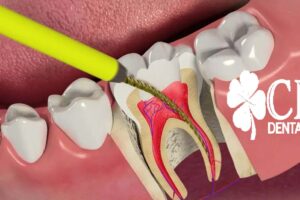 Didim Endodonti Diş Tedavisi