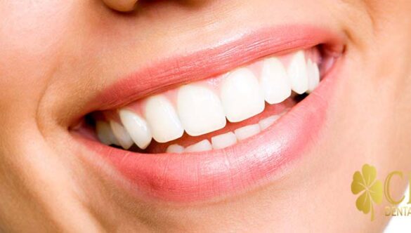 Hollywood Smile Cost in Turkey